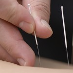Treatment by acupuncture. The doctor uses needles for treatment of the patient.