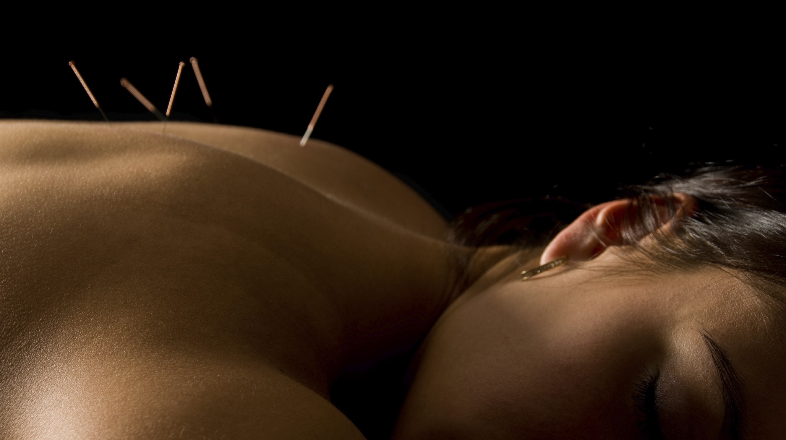 Acupuncture in Rochester NY