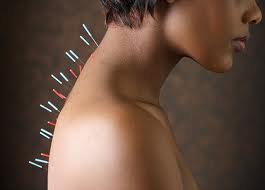 woman receiving acupuncture