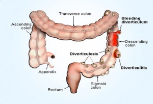 diverticulitis_s3_conditions