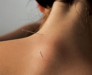 acupuncture for neck pain in Rochester NY