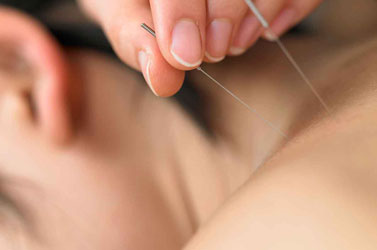 Fibromyalgia Acupuncture