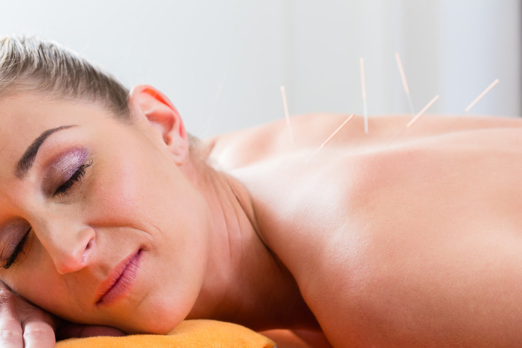 Using acupuncture therapy to stay fit over the age of 50