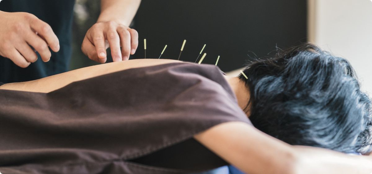 woman getting acupuncture